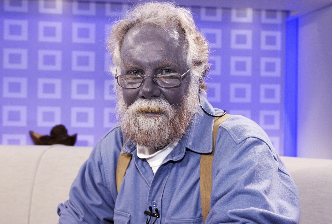 Read more about the article Colloidal Silver and Argyria – The Real Facts